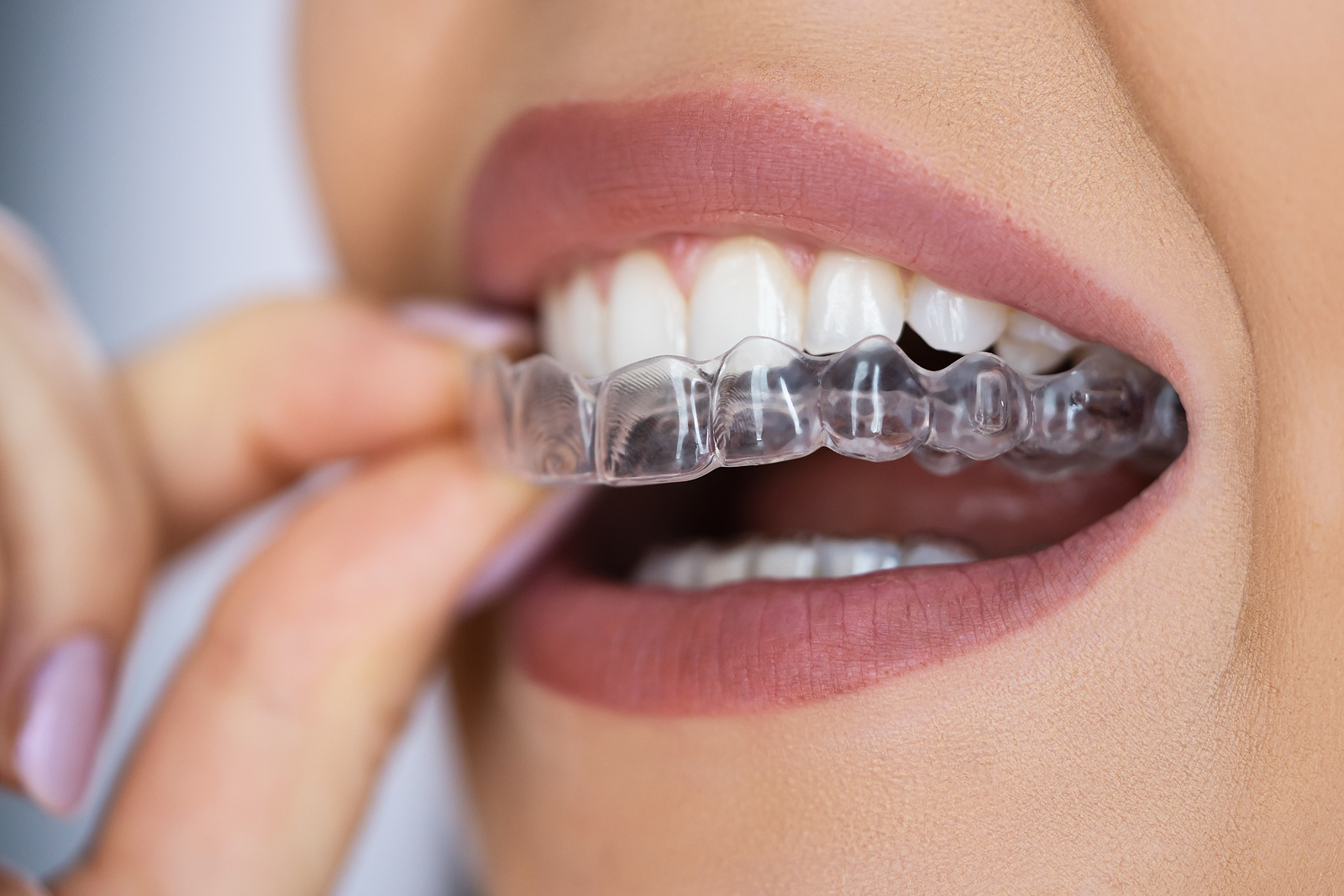 Braces & Aligners